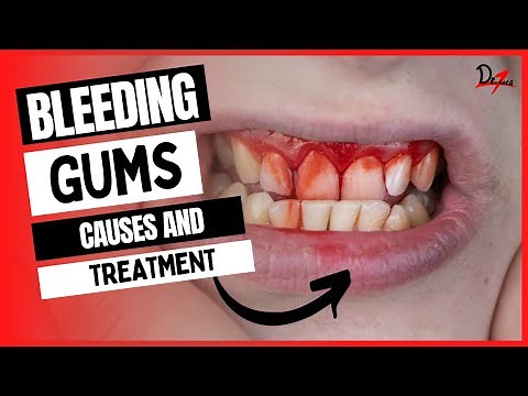 Bleeding Gums Causes & Treatment