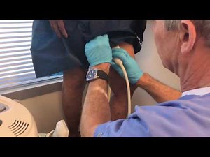 ULTRASOUND of LEFT SAPHENOFEMORAL JUNCTION REFLUX