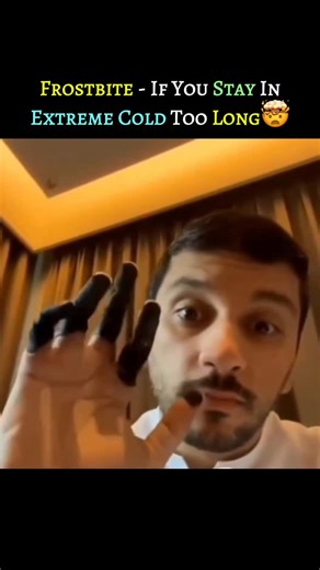 Medical | Science | Facts | Severe frostbite in fingers occurs when the skin and underlying tissues freeze due to prolonged exposure to extreme cold. In advanced... | Instagram