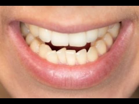 Why are my Teeth Moving? | Why are my Teeth Crooked? | Can your Teeth Move After Braces?