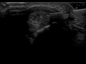 Ultrasound guided De Quervains tenosynovitis injection