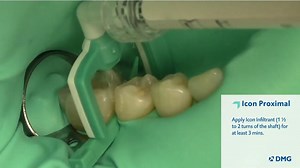 Icon Proximal Resin Infiltration Treatment - DMG America