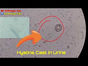 How Urine Hyaline Casts Look Under a Microscope! #PathologyRevealed