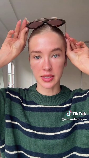 PRF update day 1! @vhskincare #undereyes #prf