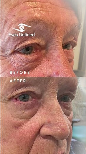 Before & After | Right Lower Eyelid Entropion Repair 👁️✨