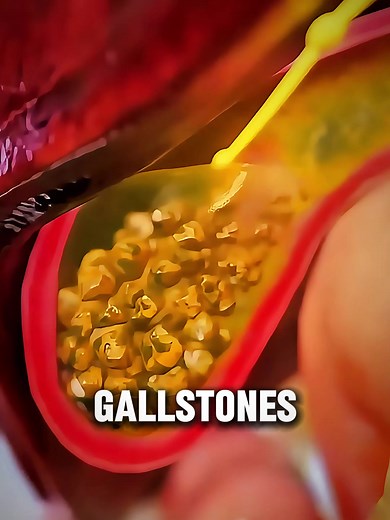 How Gallstones Form? #gallstones #digestivehealth #liverandgallbladder #3dmedicalanimation #medical3danimation