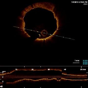 OPTICAL COHERENCE TOMOGRAPHY GUIDED ANGIOPLASTY IN A RIGHT CORONARY ARTERY. DR BINOY JOHN (JAN 2015)