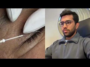 Senile Comedones | Explained by Derm