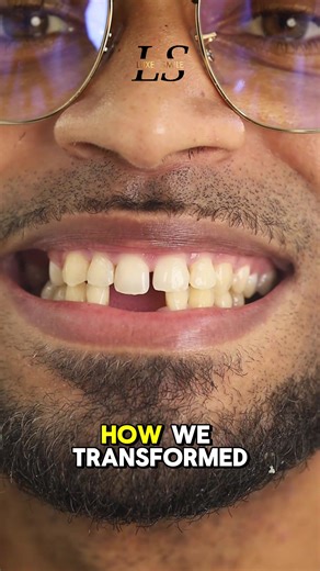 Porcelain veneers install at Luxe Smile, DM for info 🤩💎#fyp #LuxeSmile #dreamsmile #porcelainveneers #smiletransformation #veeners #foryoupage #smiles #reaction