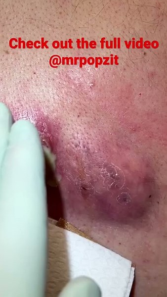 Large Double Wide Abscess. See full video - https://youtu.be/E6tX-3t1-QE?si=-wX831ckhRxvBd4O