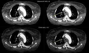 Study Search Patterns: Evaluating For Pulmonary Embolus On A CT PE Study - Stepwards
