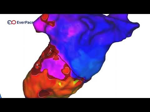 Open Window Map with Columbus 3D and High Definbition Catheter
