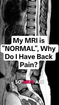 My MRI is "NORMAL", Why do I have Back Pain?