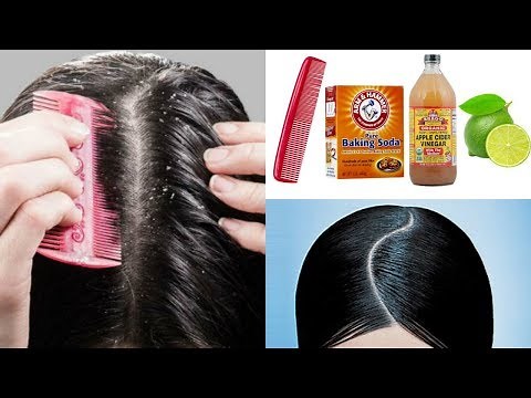 COMO ELIMINAR/QUITAR LA CASPA EN UN DIA (Remedios caseros)