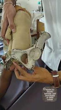 Breech delivery | Obstetrics| medicine |