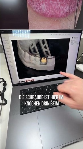 Implantat? Krone?