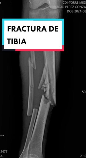 Fractura de tibia y peroné👨‍⚕️ #traumatologia #medicina #fractura #fyp#tibia