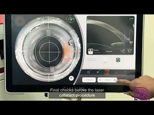 Introducing Nayana Eye Care's latest Femtosecond laser cataract surgery with Catalys Laser System