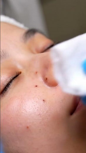 Precision Blackhead Removal | Professional Facial Extraction ASMR in 4K