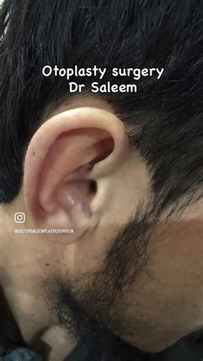 Pin back ears with otoplasty surgery