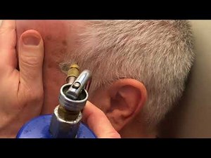 Seborrheic Keratosis Removal