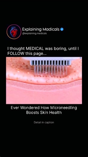 Medical | Health | Anatomy on Instagram: "Ever Wondered How Microneedling Boosts Skin Health? Microneedling works by creating thousands of tiny, controlled micro-injuries in the skin using fine needles. These microscopic punctures trigger the body’s natural healing response, stimulating the production of collagen and elastin two key proteins responsible for firm, smooth, and youthful skin. As new skin cells form, texture improves, scars and fine lines soften, and pigmentation becomes more even. 