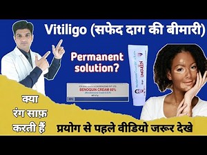 Vitiligo Parmanent treatment | Monobenzone cream for skin lightening