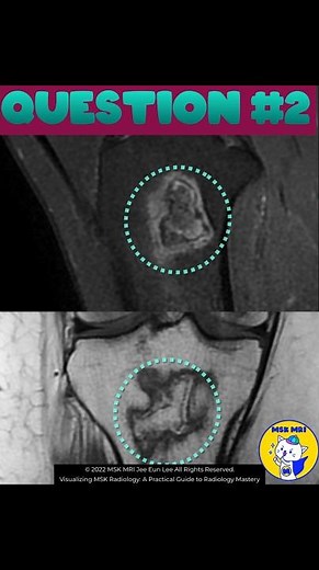 (Fig 5-E.14) Enchondroma vs. Osteonecrosis