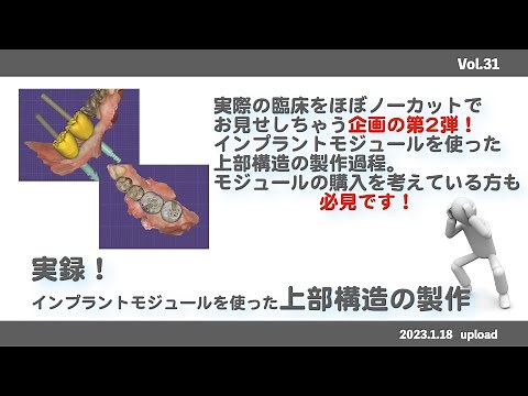 【exocad】実録！インプラント上部構造製作