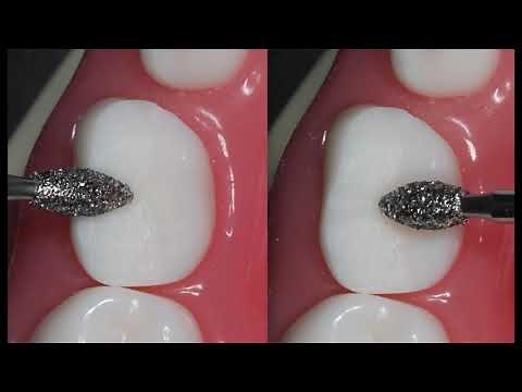 Posterior Express Prep