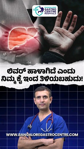 Red Palms Are Not Normal | Hidden Liver Damage Warning You Shouldn’t Ignore Many people notice redness in their palms and ignore it, assuming it’s due to heat, stress, or allergies. But when this redness is persistent, appears on both hands, and doesn’t fade easily, it may be a serious internal warning — especially linked to liver health. In this Shorts video, we break down why red palms can signal liver damage, how the body sends these early alerts, and what steps you should take next. #bangalo