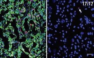 How pancreatic cancer spreads after surgery | Cold Spring Harbor Laboratory