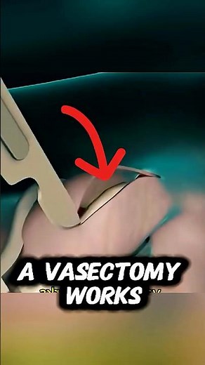 "What is a Vasectomy? 💉 | Male Birth Control Explained in 60 Seconds!" #contraception #shorts