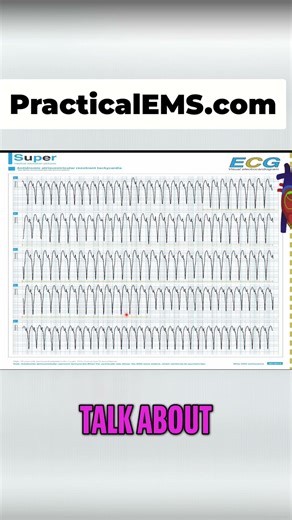 Wide QRS ECG Explained: Antidromic AVRT Breakthrough #shorts