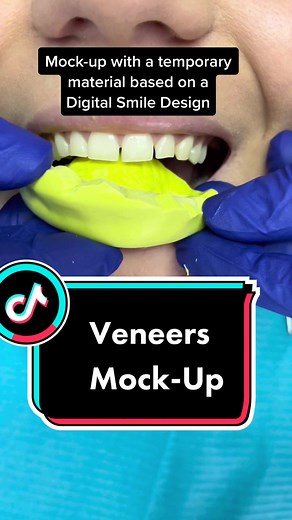 Mock-up veneers to see if the patient is suitable for non-invasive composite veneers. #dental #veneers #cosmeticdentistry #veneersjourney #teethtransformation #smilemakeover #drvesamita #dentistsoftiktok #teethtok #kosovadentist #fypp