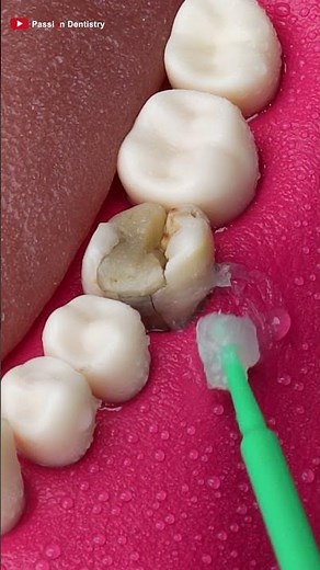 The Most Realistic Teeth ASMR Sounds #dentist#asmr