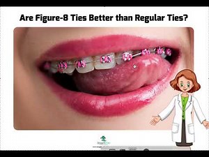 When to Use Figure 8 Ties in Braces
