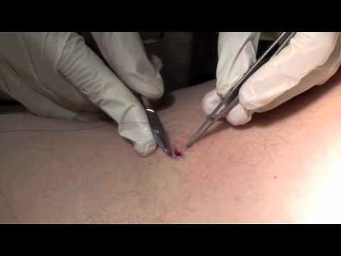 Learn about Skin Biopsies: Punch Biopsy