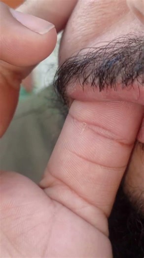 #asmr #ingrownhairremovel #satisfying #beard #pimple #skincare #blackheads #oddlysatisfyingvideo