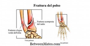 Differenza tra neuropatia assonale e neuropatia demielinizzante Differenza tra - Altri 2025