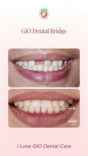 GiO Dental Bridge | Solusi Gigi Depan OMPONG