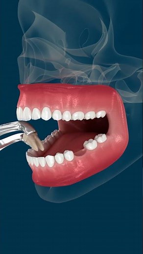 Teeth shift deformation after losing a tooth