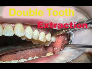 Teeth Extraction Procedure / Live Operation