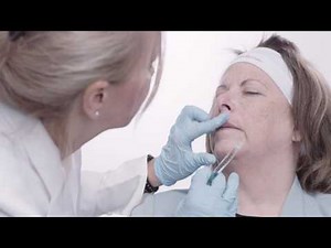 Comblement des rides péri-labiales