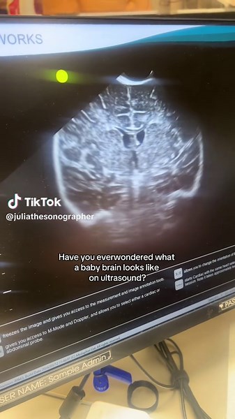 Understanding Baby Brain Development Through Ultrasound