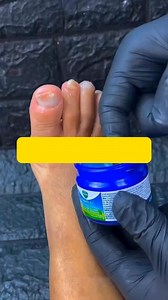 2.6K views · 43 reactions | Home remedy for nail fungus Got nail fungus?  This home remedy with baking soda, vinegar, and Vicks Vaporub is the solution you've been looking for. Make this natural mixture to eliminate fungus and leave your nails clean and healthy. It works on hands and feet! ✨ #NailFungus #HomeRemedy #HealthyNails #NaturalTreatment #BakingSoda #Vinegar #VicksVaporub #HealthyFeet #HealthyHands #ForYou | Julian Ramirez | Facebook