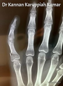 Closed reduction and K wiring of base of proximal phalanx.