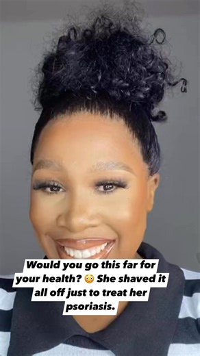 TheWatsons | Would you go this far for your health? 😳 She shaved it all off just to treat her psoriasis. Some call it extreme, others call it brave.... | Instagram