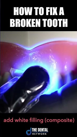 How to Fix a Broken Tooth | Complete Dental Procedure | Permanent Filling| Polishing| Shorts