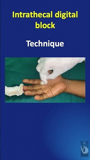 Shorts #43: How to give the very easy Intrathecal digital block and all about it - in a minute!